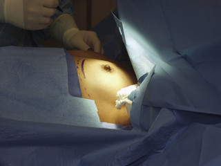 marking points for incision before surgery