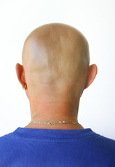 baldness