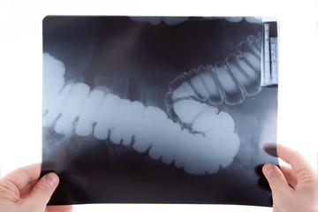 doctor examining an abdominal x-ray - obrazy, fototapety, plakaty