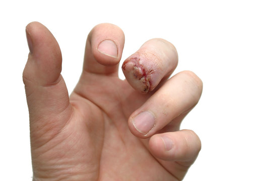 missing fingernail