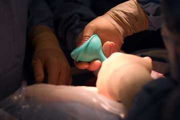 c-section