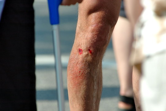 sch&uuml;rfunde am knie