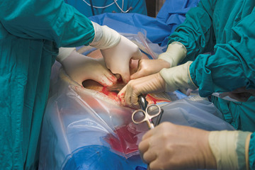 cesarean section birth