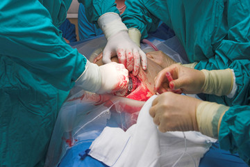 cesarean section birth