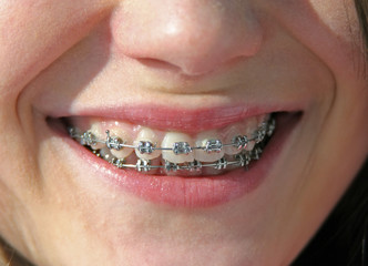 Obraz premium smile with brackets on teeth
