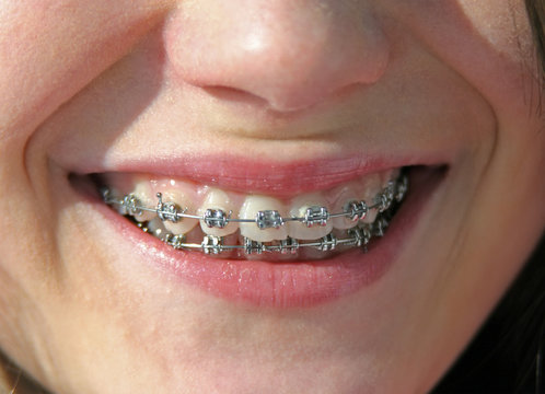 smile with brackets on teeth