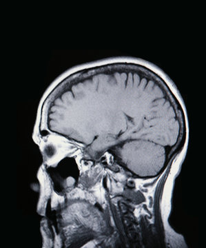 a real mri/ mra (magnetic resonance angiogram) of the brain