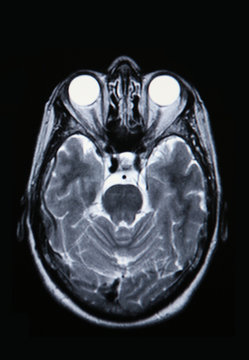 a real mri/ mra (magnetic resonance angiogram) of the brain vasc