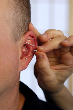 acupuncture needles in ear