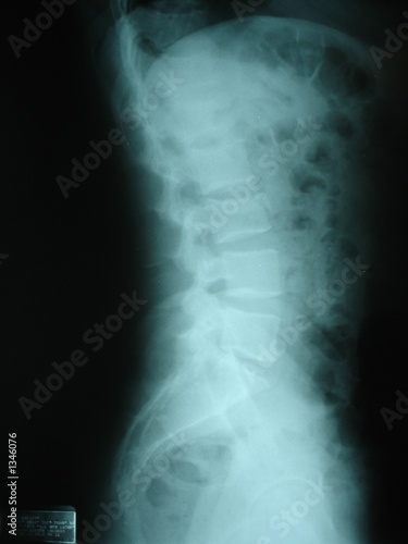 "3rd lumbar vertebrae fracture" Stock photo and royalty-free images on