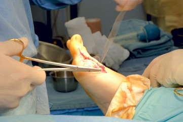 foot surgery - bunionectomy - suturing