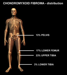 chondromyxoid fibroma