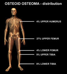 osteoid osteoma