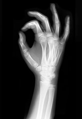 x-rayed hand