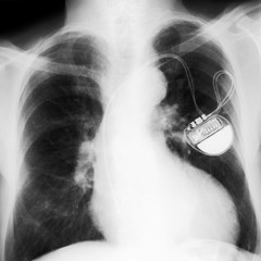 x-rayed chest