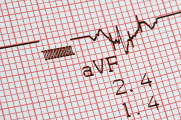cardiographical test results
