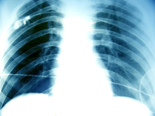 human chest tomography