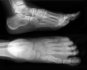 foot-x-ray