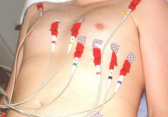 ecg