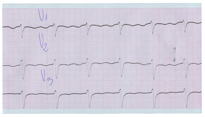 long stripe of ecg