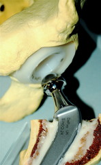 ball and socket