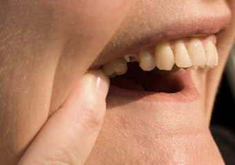 missing tooth