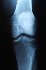 x ray photo of human knee - 3147001