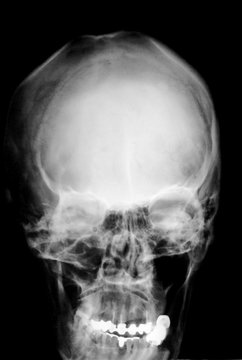 x-ray of deformed skull