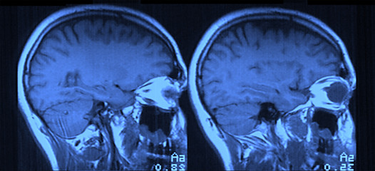 MRI Head