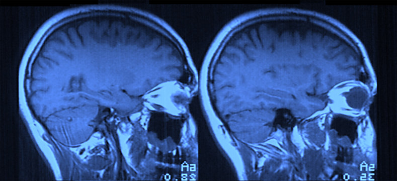 MRI Head