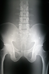 X-ray phantom pelvis
