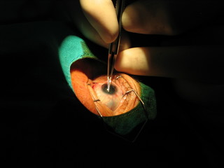 Eye surgery close up (cataract removal)