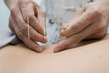 Treatment by acupuncture - obrazy, fototapety, plakaty
