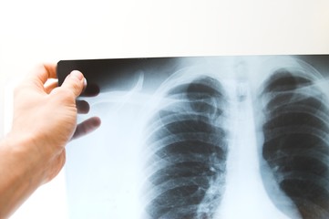 x-ray picture of human chest