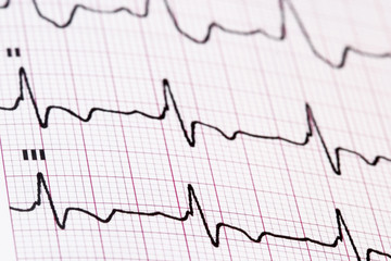 EKG - medical background