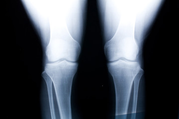 knee x-ray photo