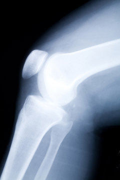 knee x-ray photo