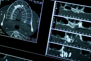 Tomography of mouth