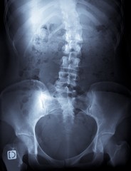 x-ray of a young female spine