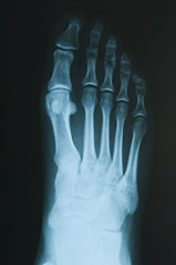 Radiografia del piede
