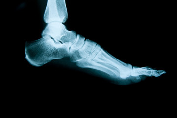 Radiografia del piede