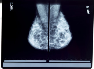 x-ray mammogram