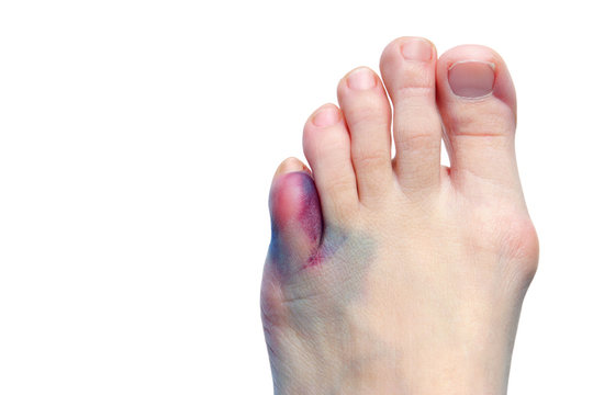 Bruises, bunions  and broken toes
