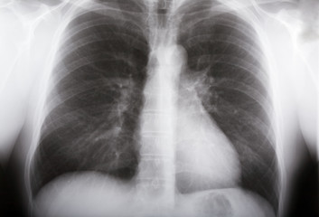 lungs xray