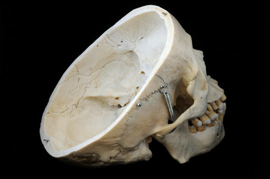 A real human skull with the cap cut away