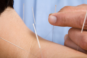 Acupuncture needles on back of a young woman