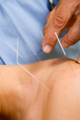 Acupuncture needles on back of a young woman