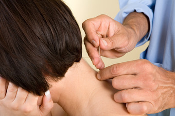 Acupuncture needles on back of a young woman