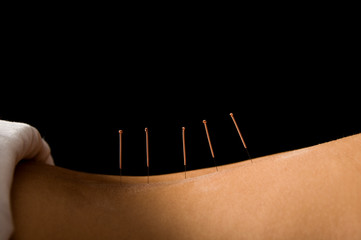 Acupuncture