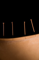 Acupuncture